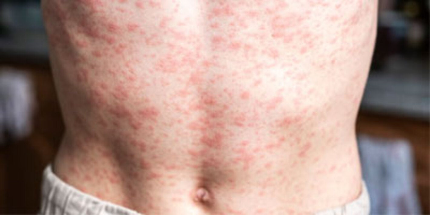 PAHO calls for regional action as the Americas lose measles elimination status