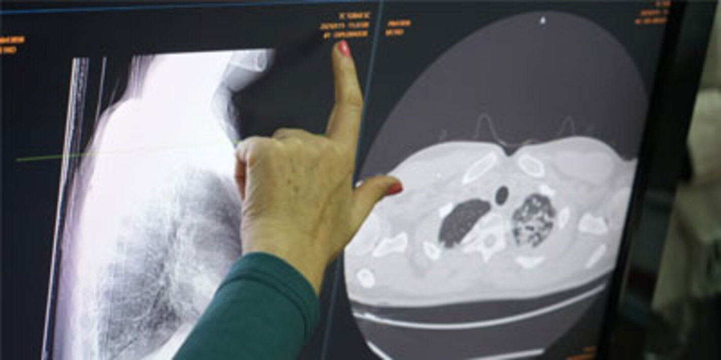 Día Mundial de la Tuberculosis 2026: la atención primaria de salud, clave para una respuesta más accesible y centrada en las personas
