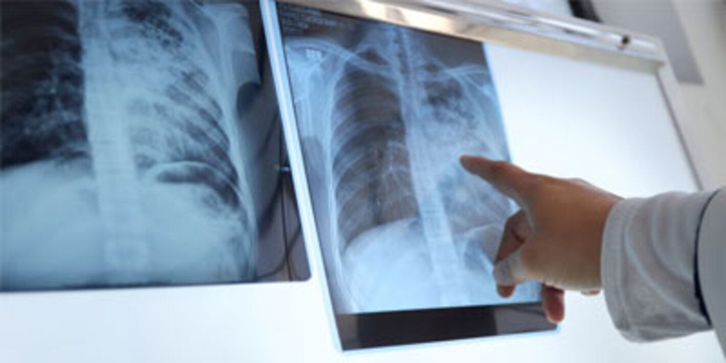 TB/HIV Webinar Series: Diagnostic innovations for the early detection of tuberculosis in people with HIV