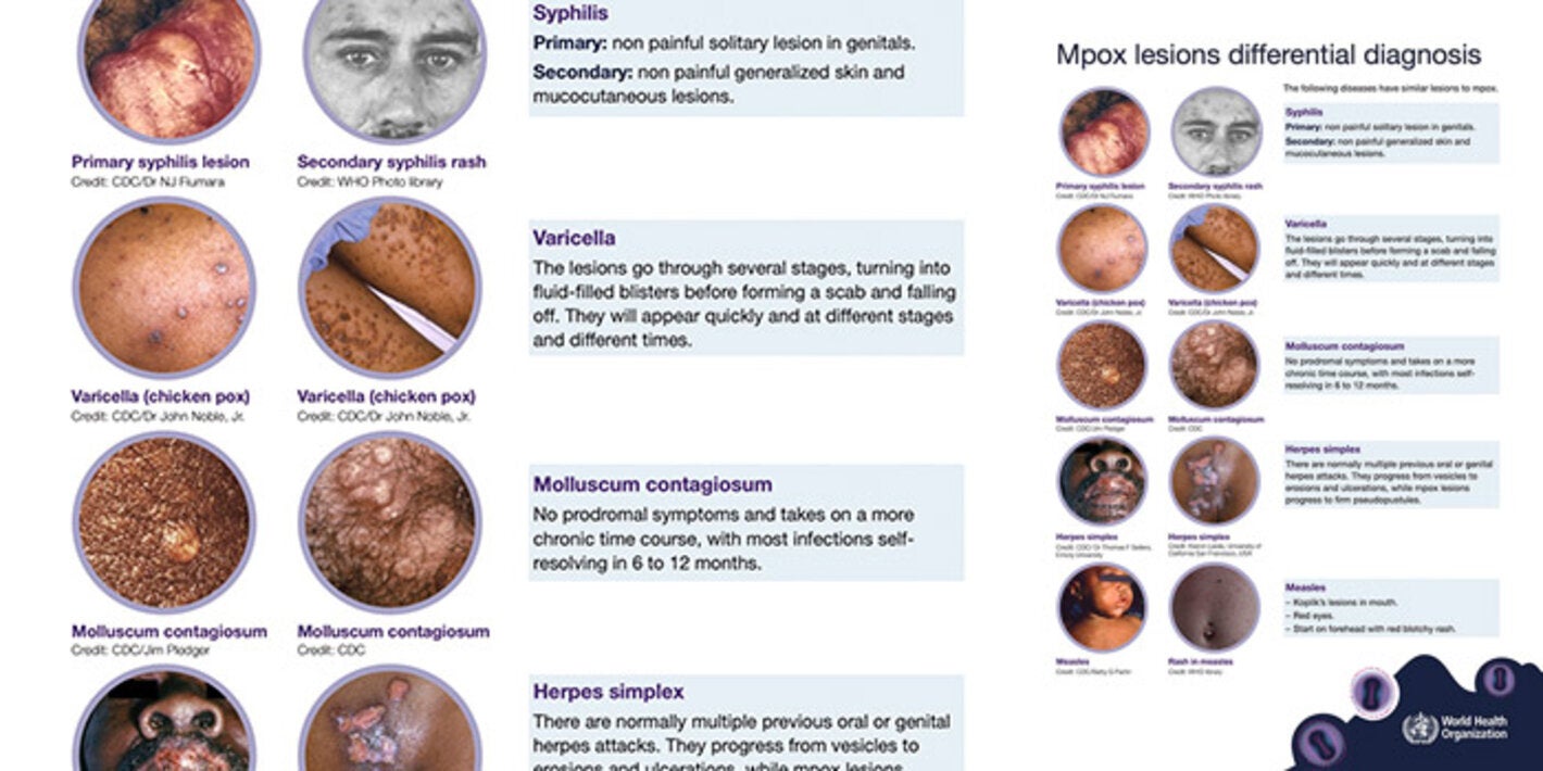 Herramienta de cribado mpox