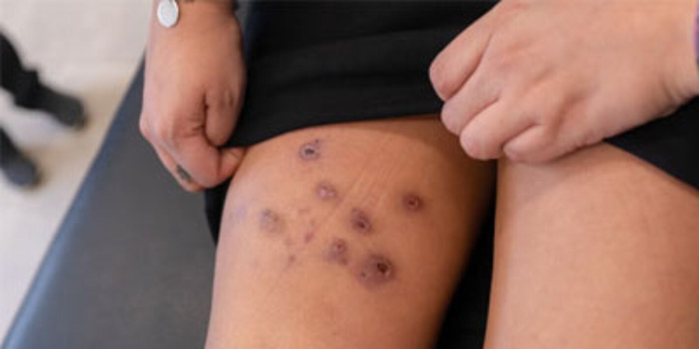 Peru shows progress in tackling neglected tropical diseases