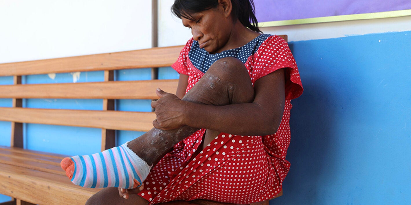 Tungiasis and the guardians of the Amazon