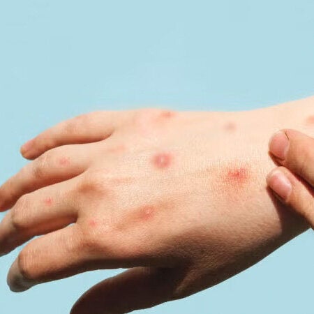 Mpox viruela símica síntomas en un mano