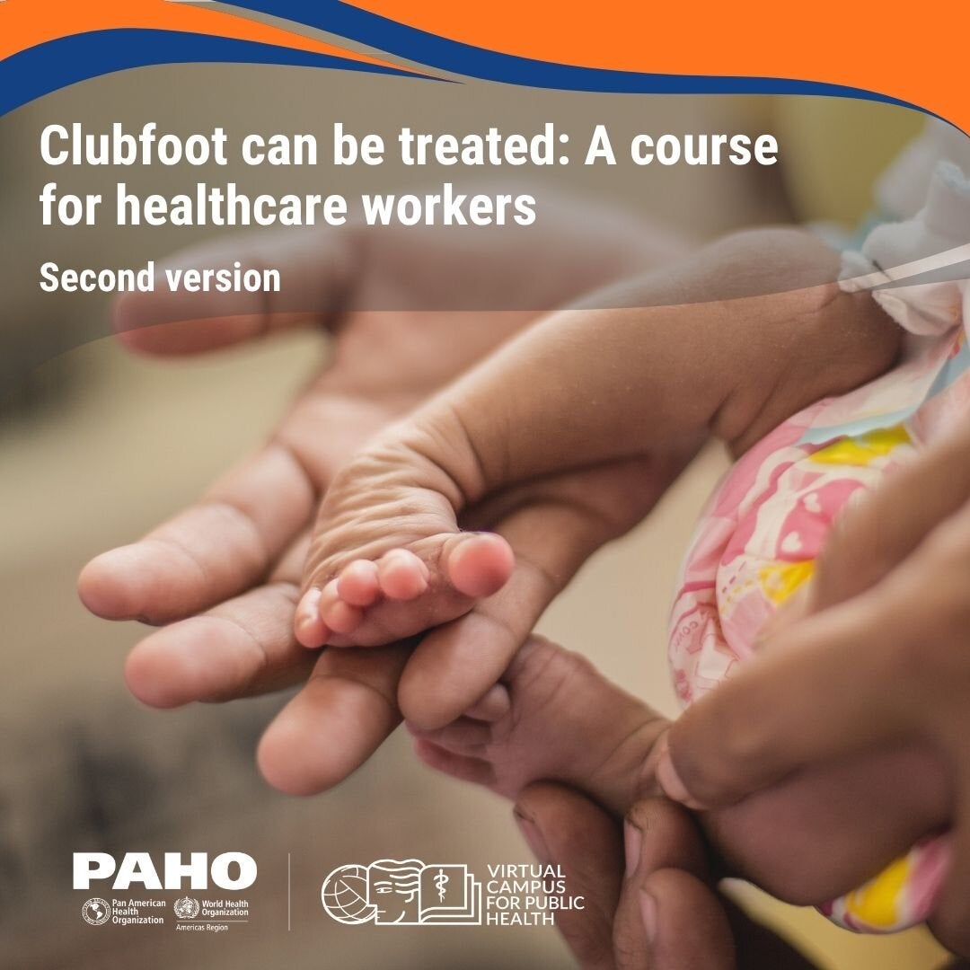 Photo of a newborn baby's clubfoot in an adult's hands.