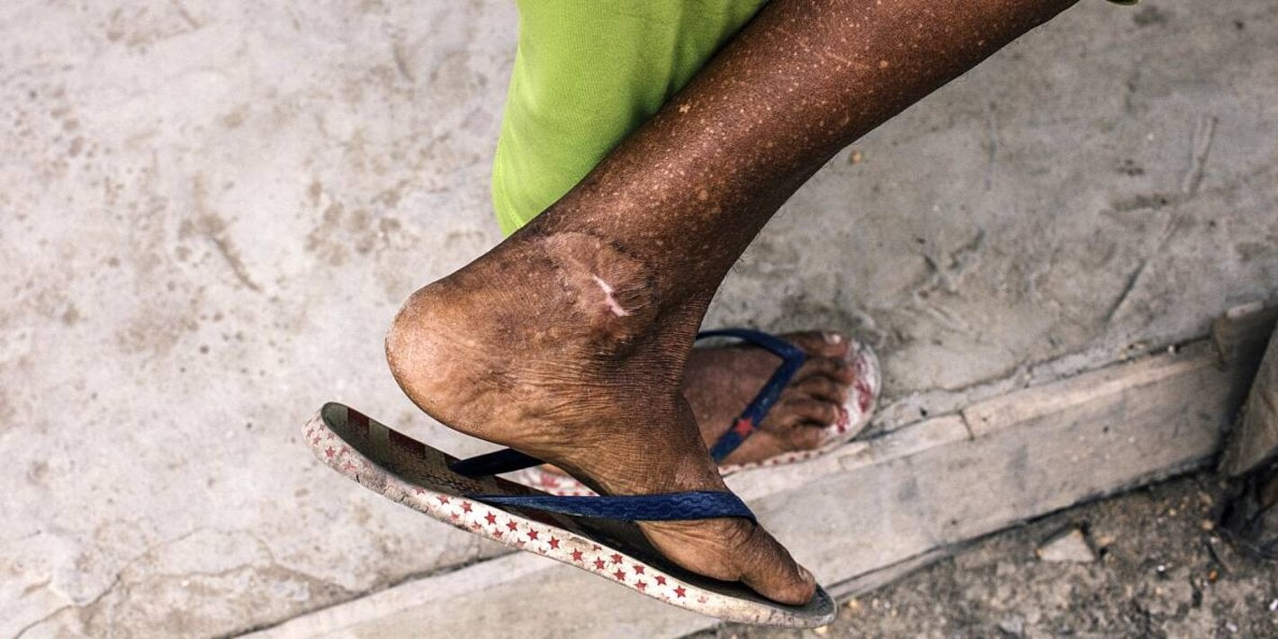 Man affected by cutaneous leishmaniasis