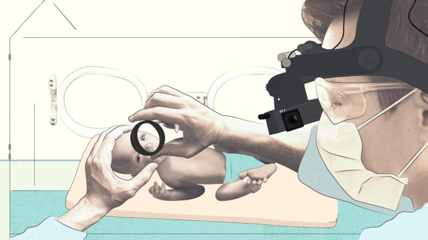 ilustración-Retinopatía-de-la-prematuridad