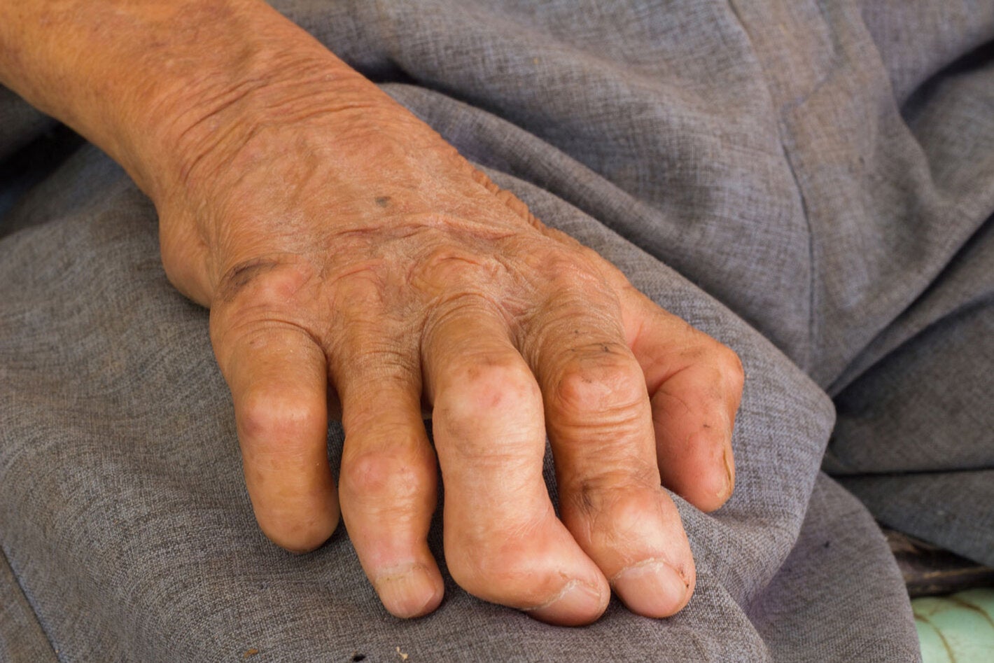 Left hand of a older man impacted by leprosy