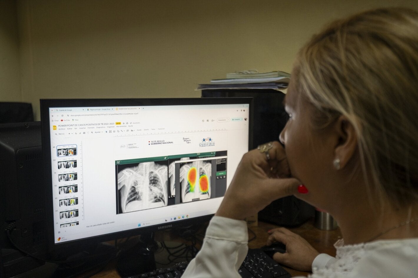 Imaging being used to diagnose tuberculosis
