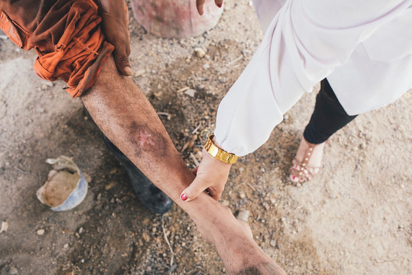 Persona con lesión característica de la leishmaniasis cutánea