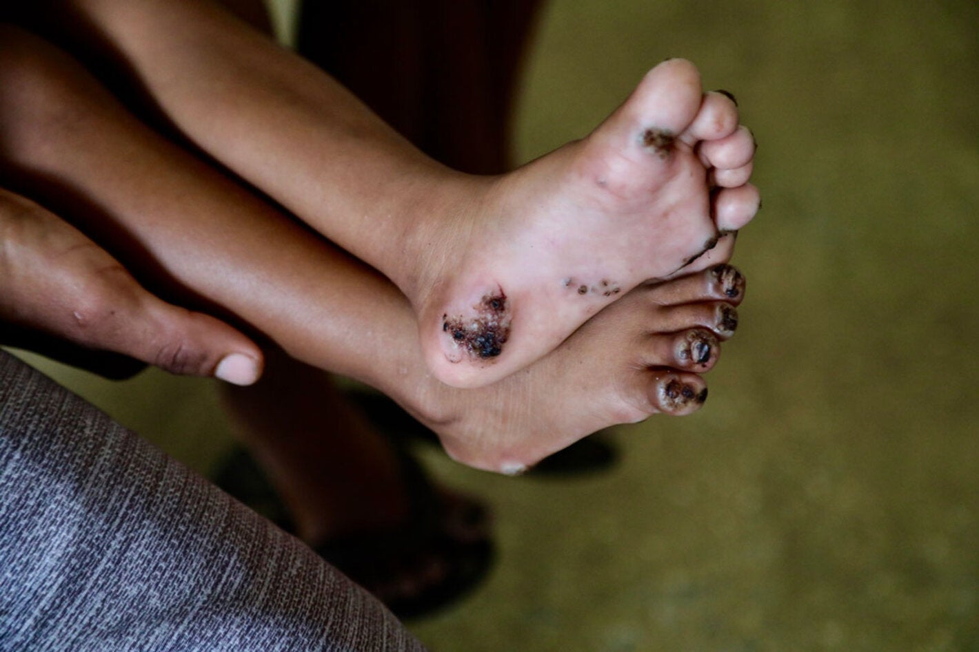 Pies afectados por la tunguasis. La tungiasis es una enfermedad tropical desatendida causada por la pulga de arena hembra Tunga penetrans, que se incrusta en la piel, principalmente en los pies, provocando una inflamación intensa, dolor y picazón.