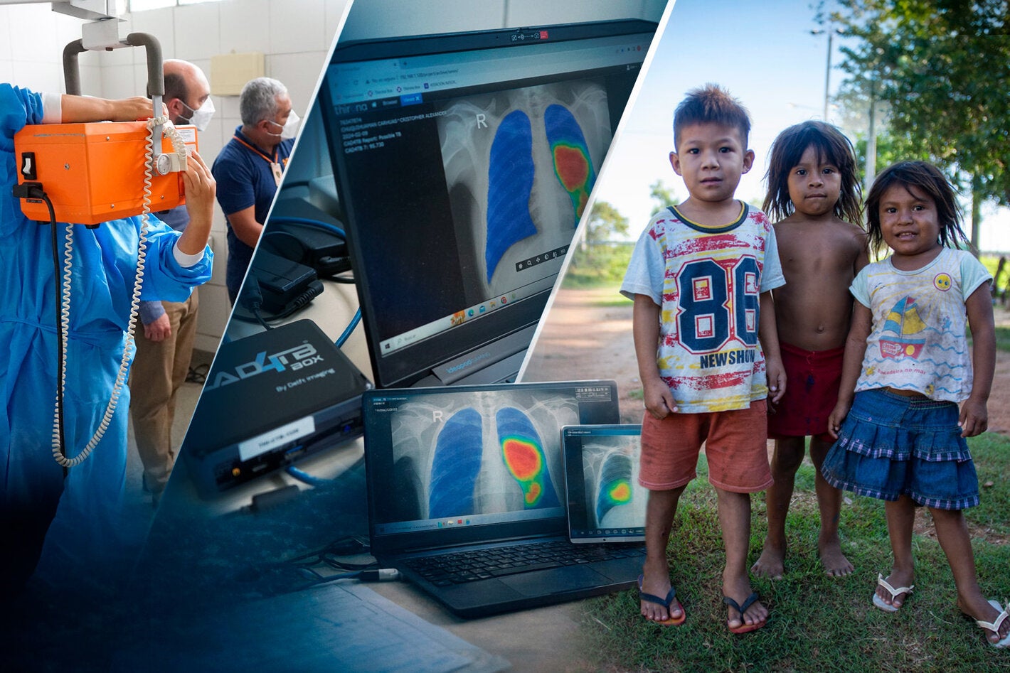 Podemos poner fin a la tuberculosis