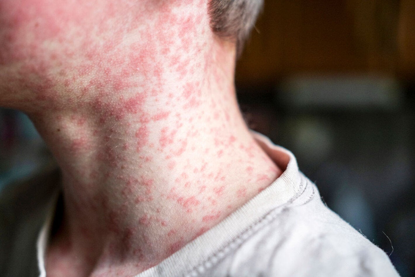 measles patient
