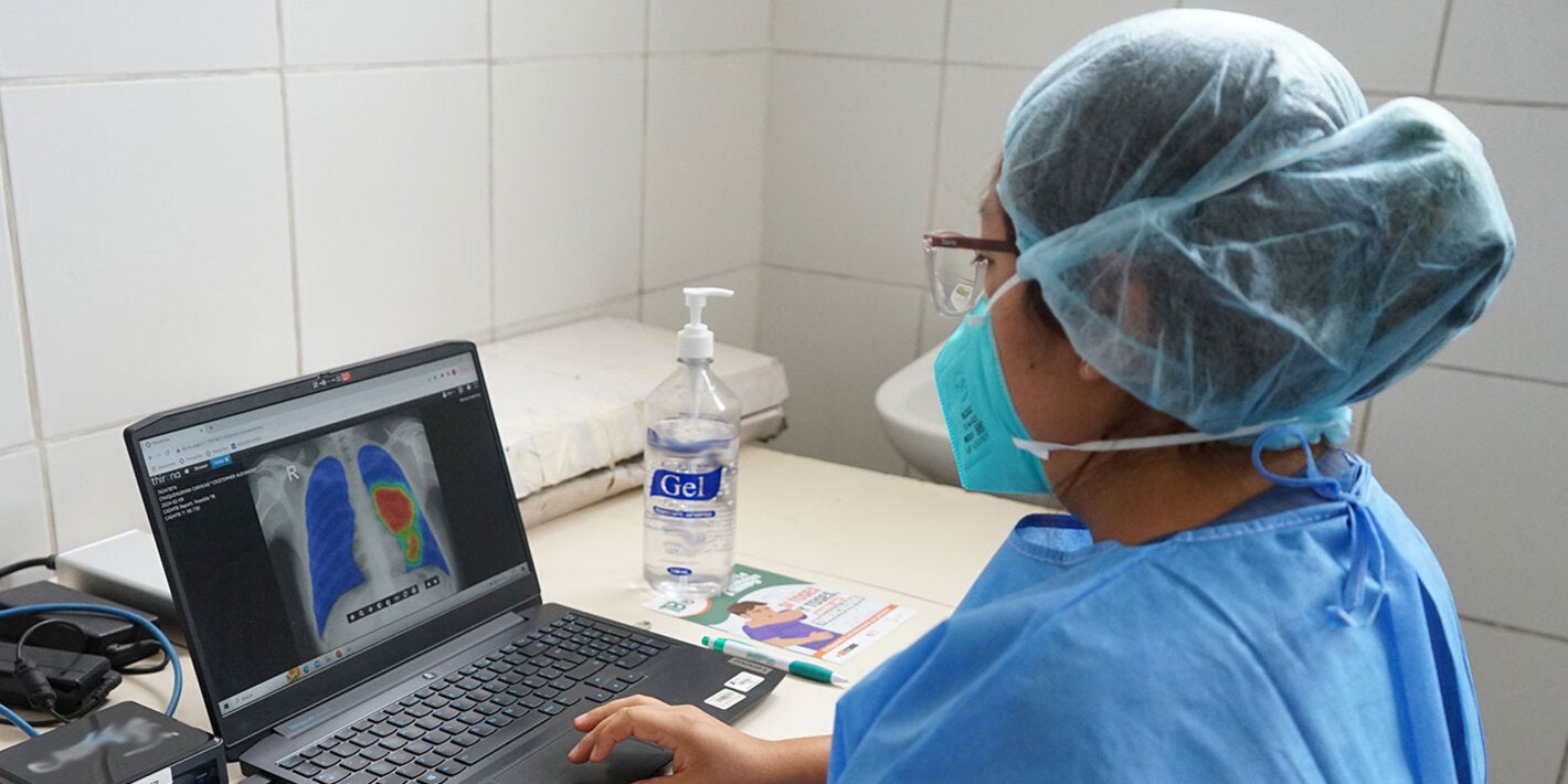 IA asiste en el diagnóstico de la tuberculosis