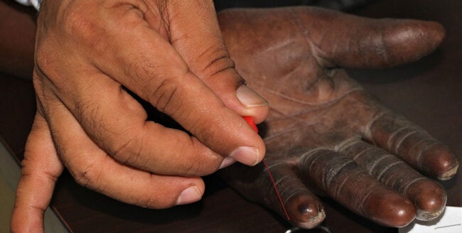洋書 Leprosy Stigma and Control Activities Stigma and discrimination prevent early diagnosis and treatment of