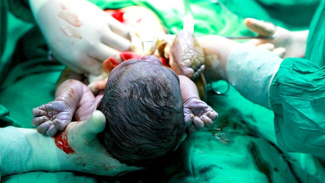 Emergency Caesarean section