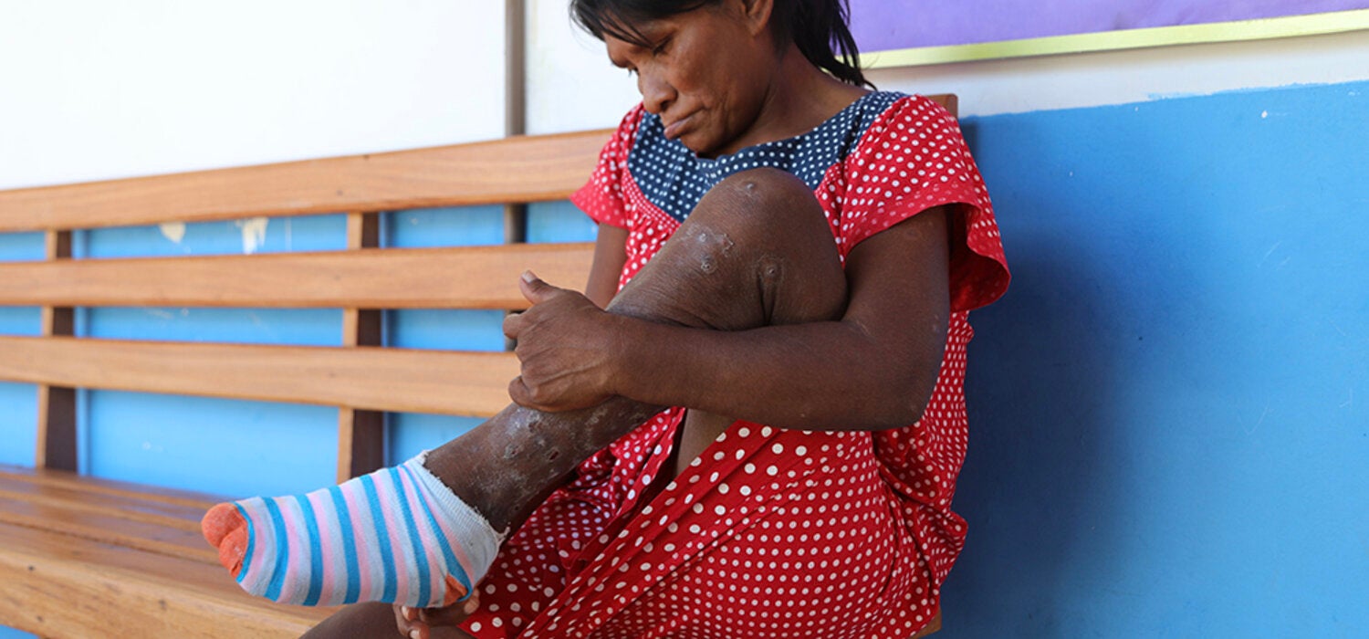 Tungiasis and the guardians of the Amazon