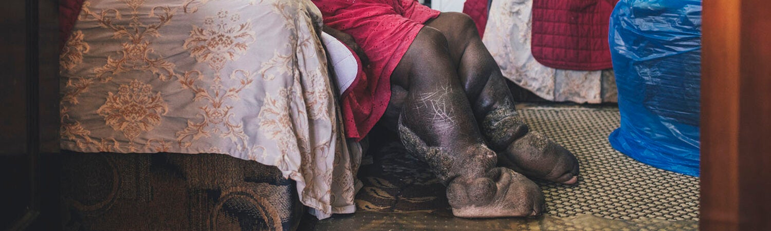 Lymphatic Filariasis